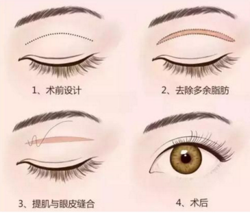 全切雙眼皮手術(shù)出血大不大