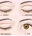 全切雙眼皮手術出血大不大