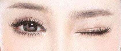 雙眼皮術(shù)后要注意什么呢