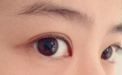 雙眼皮術(shù)后要注意什么呢