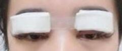 全切雙眼皮的疤痕要怎么處理