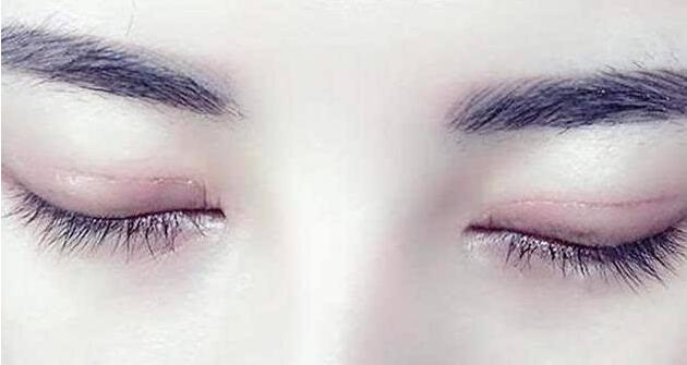 全切雙眼皮手術(shù)什么時(shí)候拆線