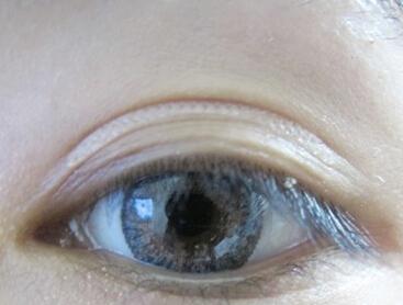 三眼皮變雙眼皮