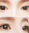 埋線雙眼皮需要注意的事項有哪些