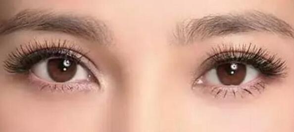 埋線雙眼皮有缺點嗎