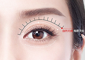 雙眼皮手術(shù)失敗會(huì)有什么癥狀