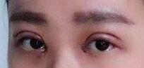 雙眼皮手術失敗了還能修復補救嗎
