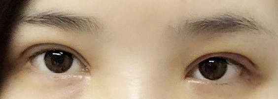 做切開雙眼皮手術會有疤痕嗎