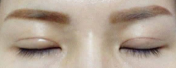 做切開雙眼皮手術會有疤痕嗎