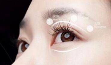 埋線雙眼皮效果能維持多少年