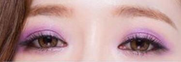 雙眼皮失敗的主要原因有哪些