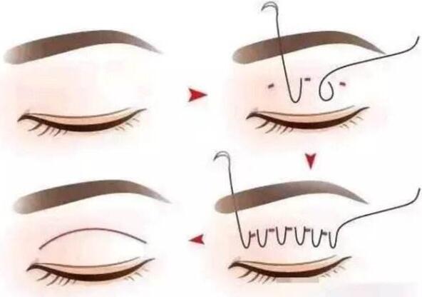 廣州做埋線雙眼皮手術(shù)多少錢