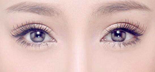切開雙眼皮術(shù)后有什么問題要注意