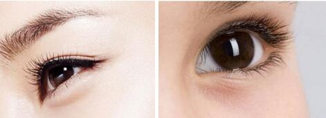 埋線雙眼皮會(huì)出現(xiàn)斷線的情況嗎