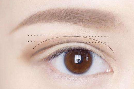 切開法雙眼皮多少錢