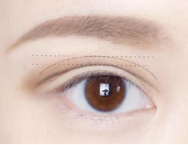 內(nèi)雙適合做切開雙眼皮嗎