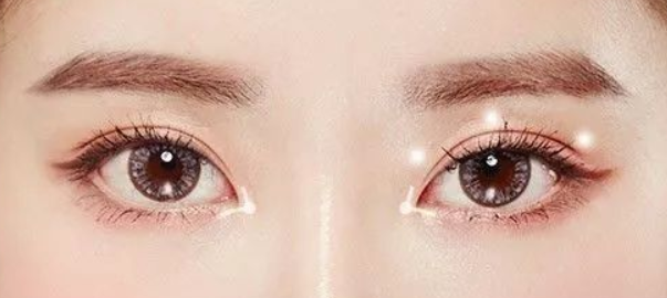 做雙眼皮手術(shù)會失敗嗎