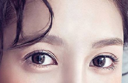 做切開雙眼皮手術(shù)要注意什么