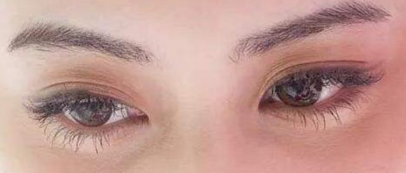 雙眼皮術(shù)后需要做好的護(hù)理事項(xiàng)