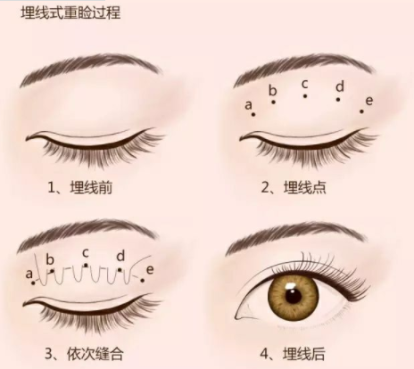 埋線雙眼皮的術(shù)后護(hù)理怎么做