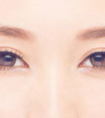 埋線雙眼皮的術(shù)后護(hù)理怎么做