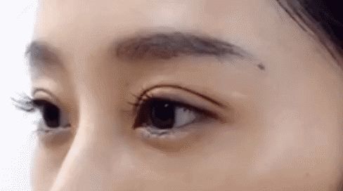 雙眼皮手術(shù)后怎么護理恢復更快