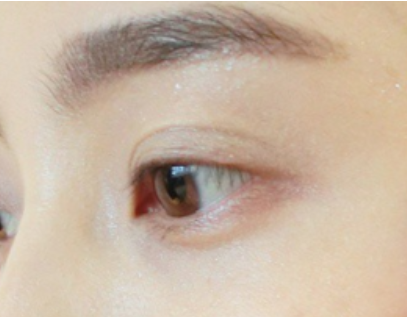 切開雙眼皮有哪些優(yōu)勢(shì)