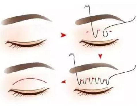 埋線雙眼皮失敗多久可以重做