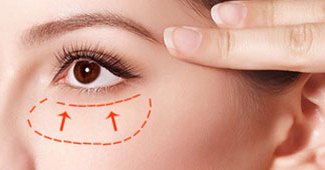 做手術(shù)快速消除眼袋安全嗎