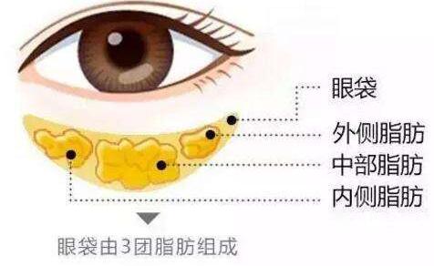 手術(shù)切除眼袋要不要住院