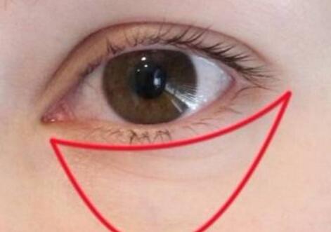手術(shù)切除眼袋會有后遺癥風(fēng)險嗎