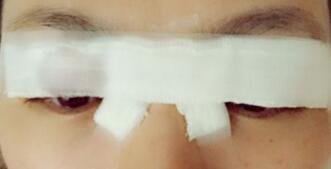 雙眼皮手術(shù)失敗了能修復(fù)多少次