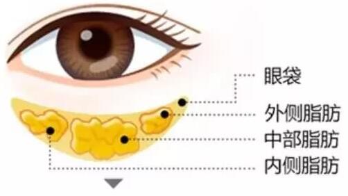 手術(shù)切除眼袋要注意哪些事項(xiàng)