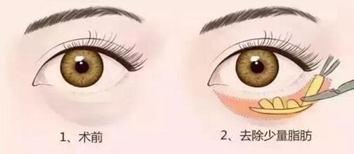 手術(shù)切除眼袋要注意哪些事項(xiàng)