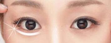 眼袋形成的原因及祛除方法