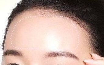 自體脂肪填充面部會(huì)有后遺癥風(fēng)險(xiǎn)嗎