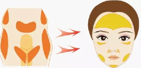 自體脂肪填充面部價格是多少