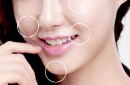 自體脂肪填充臉部會有后遺癥嗎