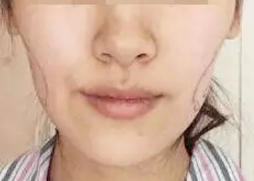 自體脂肪填充面部會有血腫嗎