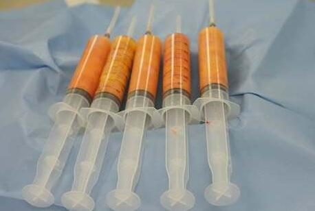 自體脂肪填充的效果可以保持多久