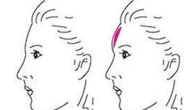 自體脂肪豐額頭好不好呢