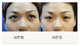 治療黑眼圈案例一