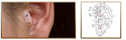 美萊中醫(yī)健康減肥方法-耳穴減肥效果