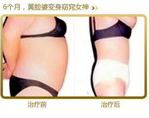 美萊中醫(yī)健康減肥案例-黃臉婆變身窈窕女神
