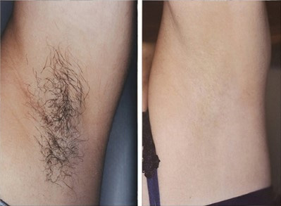 miraDry微波腋汗術臨床真實案例圖1