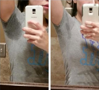 miraDry微波腋汗術臨床真實案例圖2