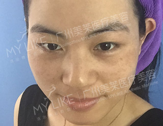 術(shù)前 ― 側(cè)面