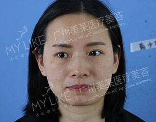 一個療程 ― 側(cè)面