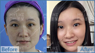 雙皮秒祛雀斑前后對比