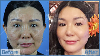 雙皮秒祛黃褐斑前后對比